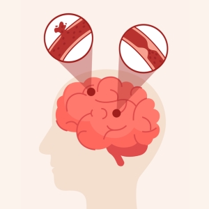 Stroke Paralysis treatment best doctor clinic ecil hyderabad